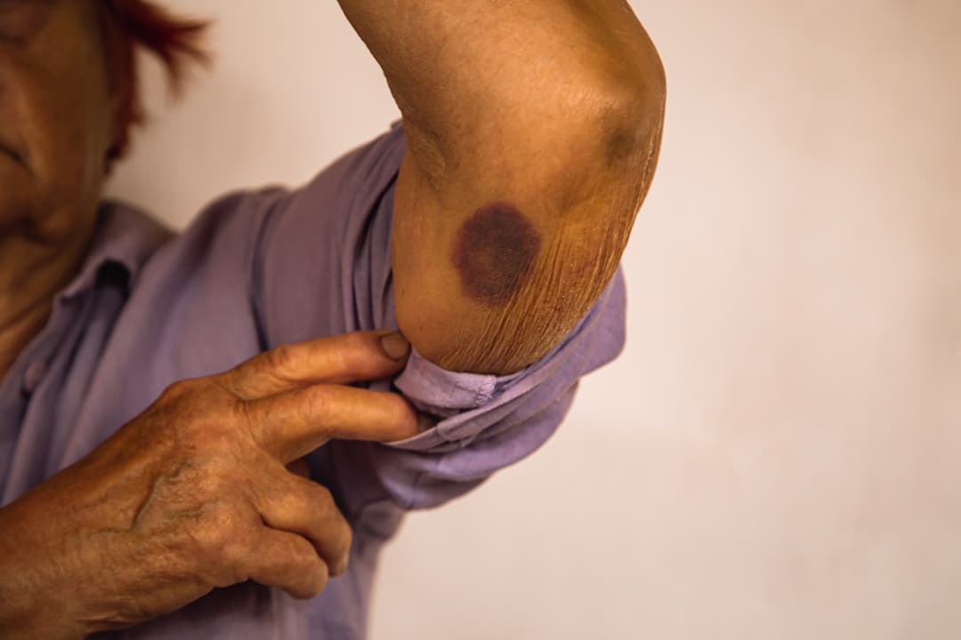 physical abuse